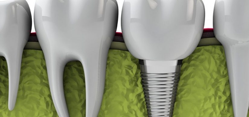 nhakhoa-implant-q1-848x518