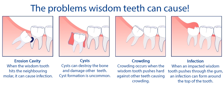 Blog-wisdom-teeth2