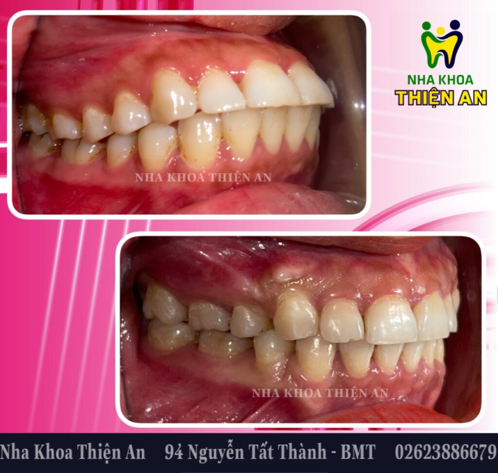 niềng răng có đau không