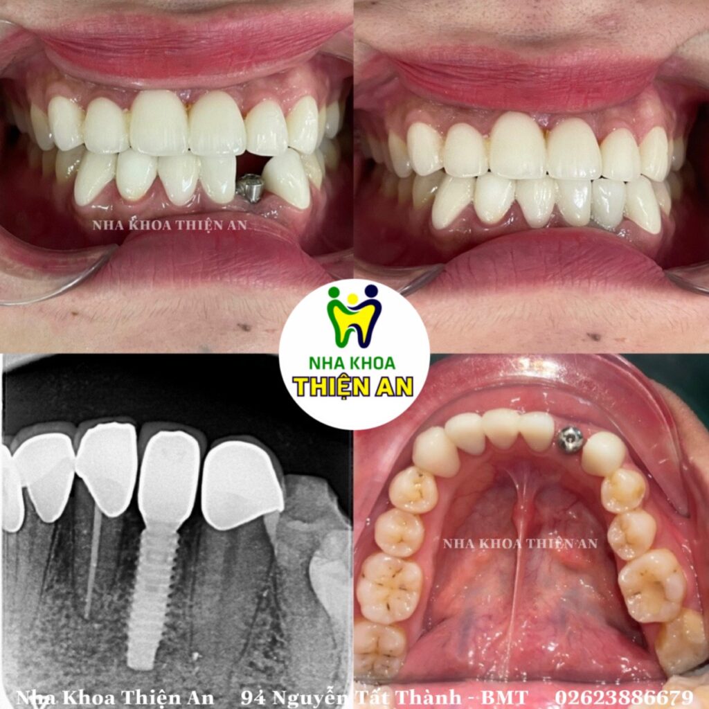 trồng răng implant có đau không