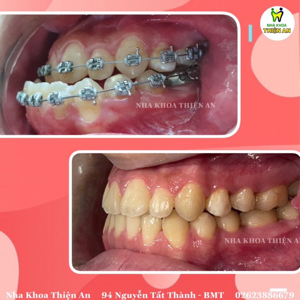 niềng răng có đau không