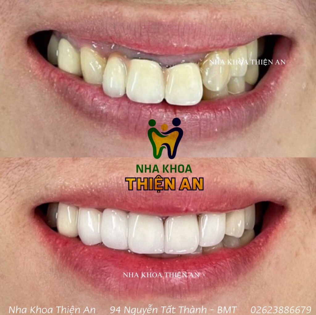 răng sứ thẩm mỹ