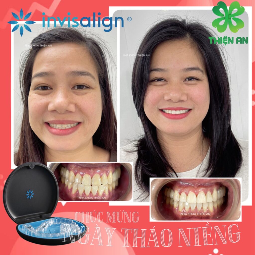 niềng invisalign