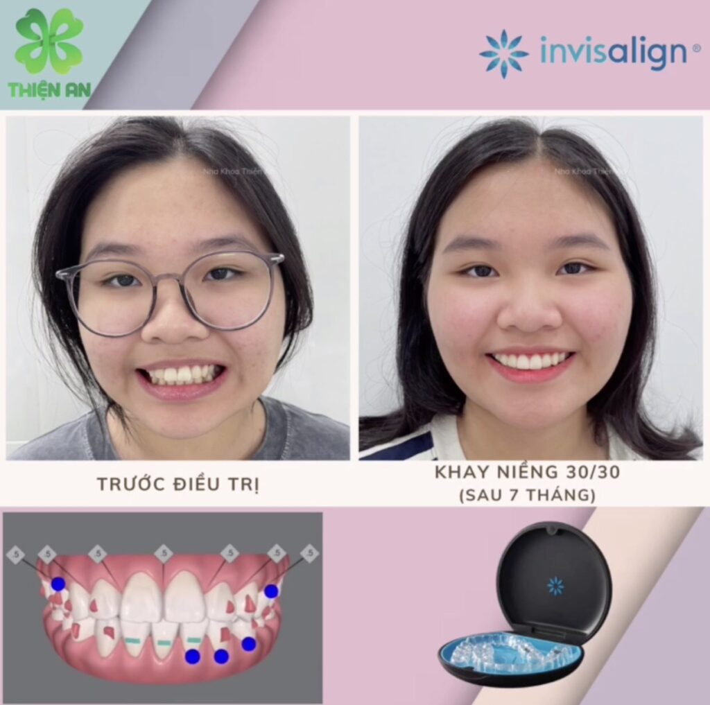 niềng invisalign