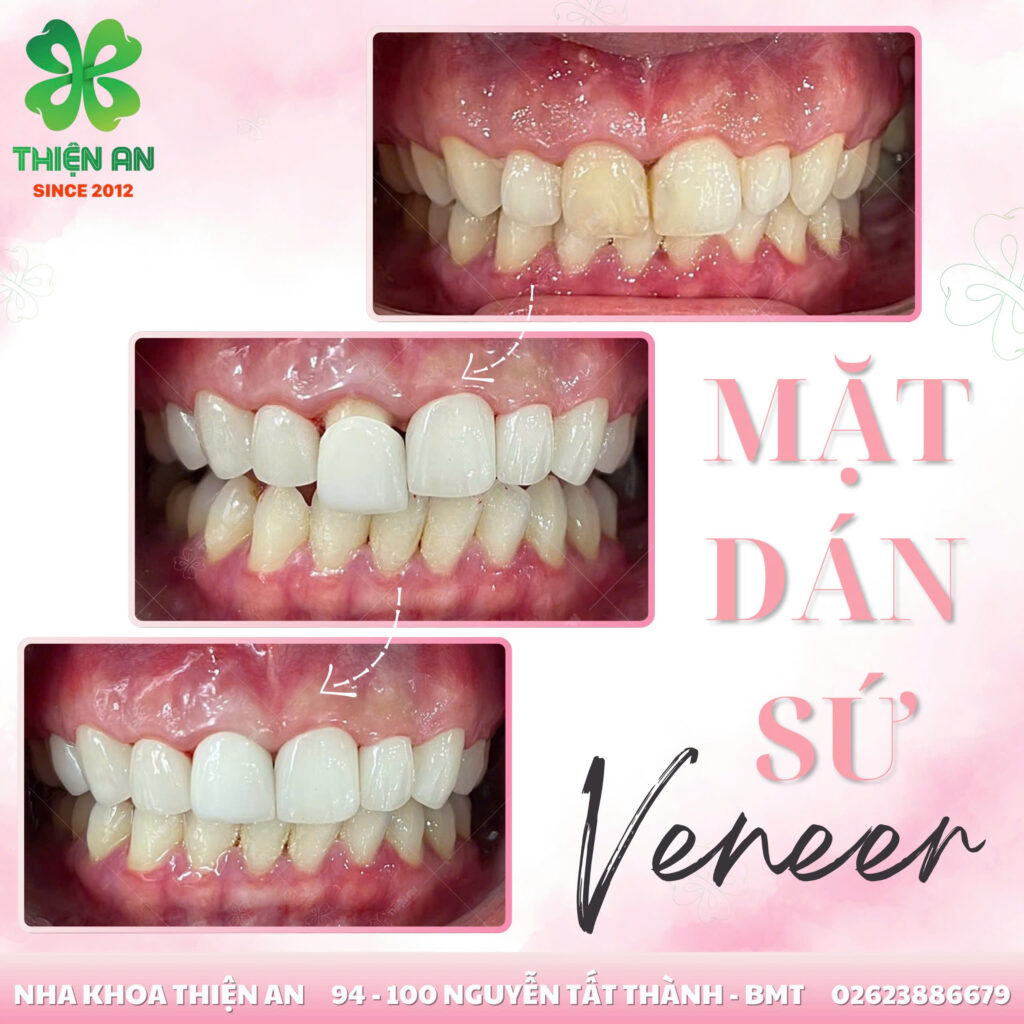 veneer