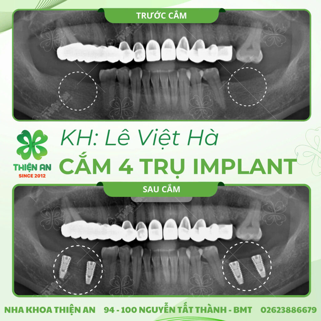 implant