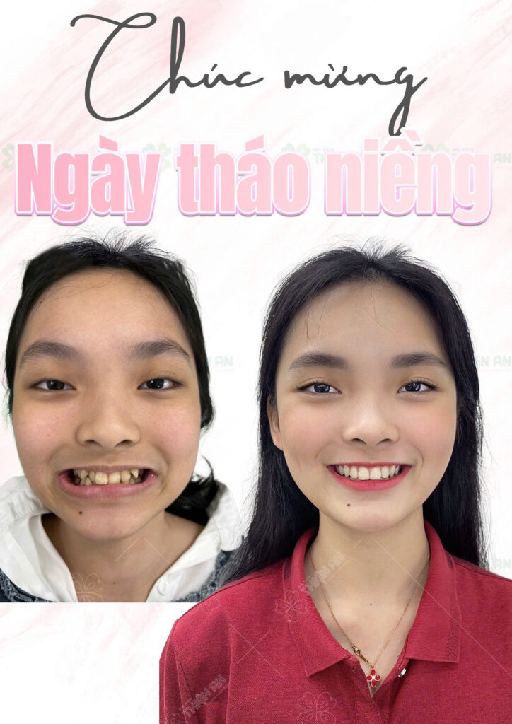 tháo niềng