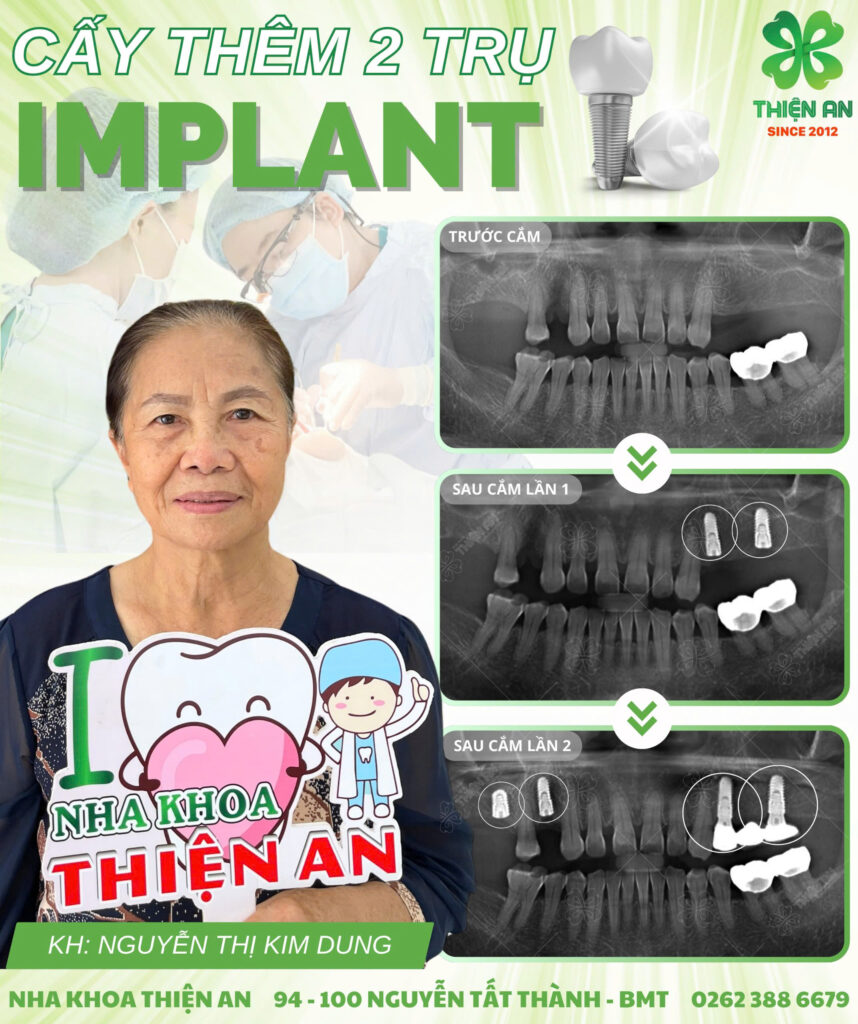 implant