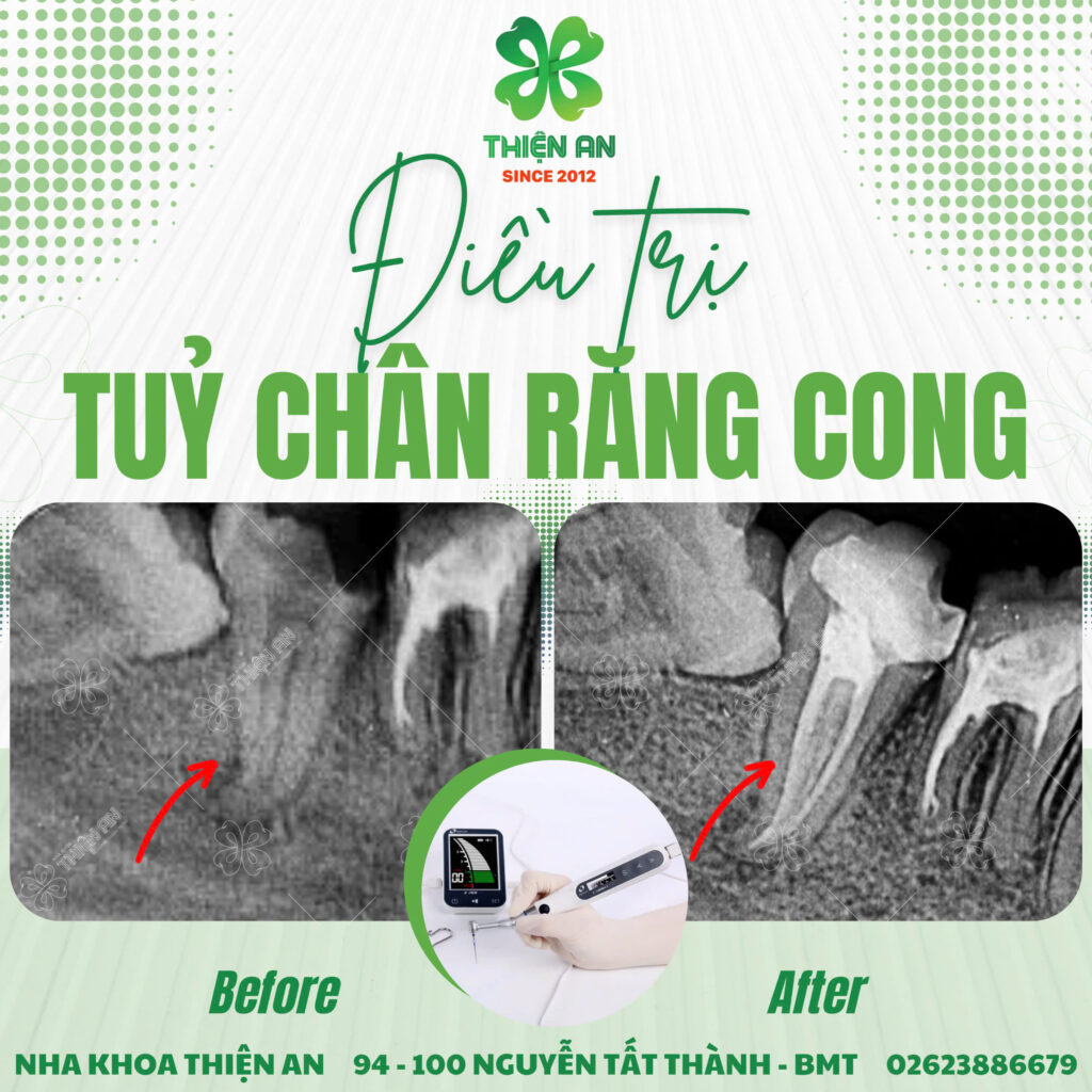 tủy