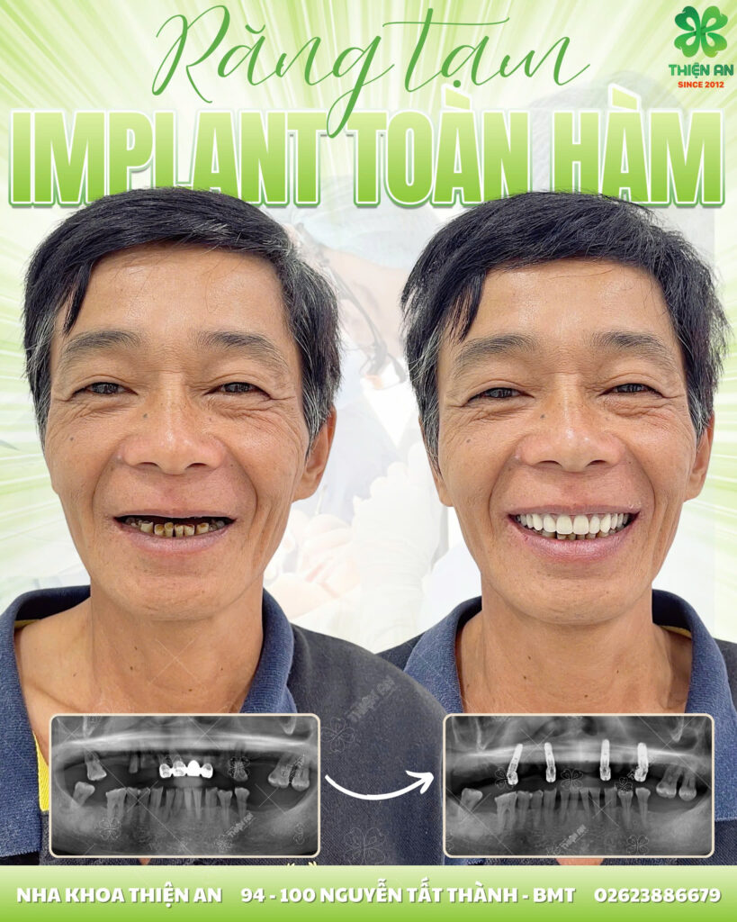 implant