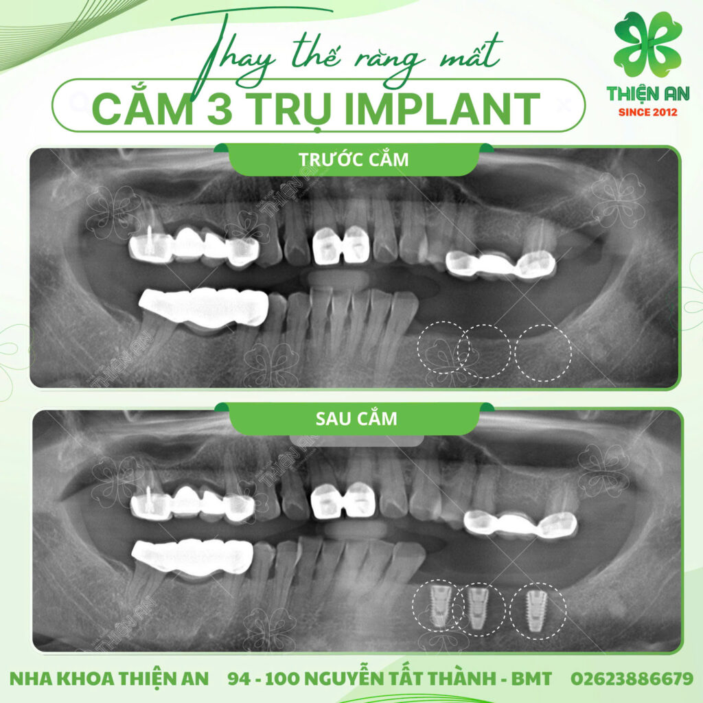implant