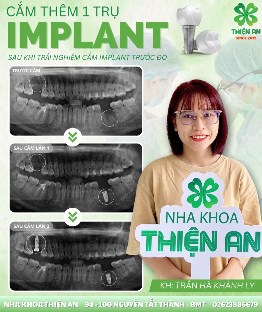 implant