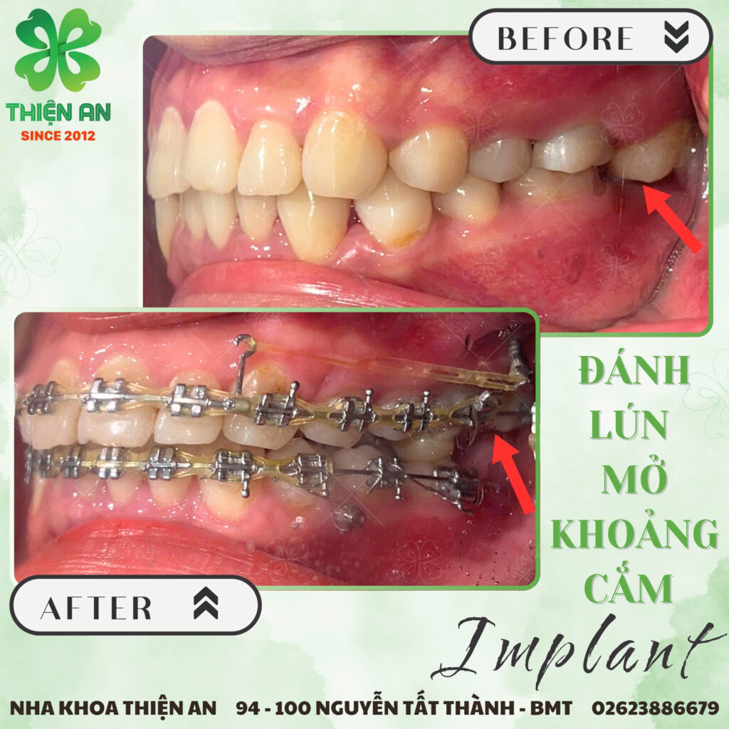 implant