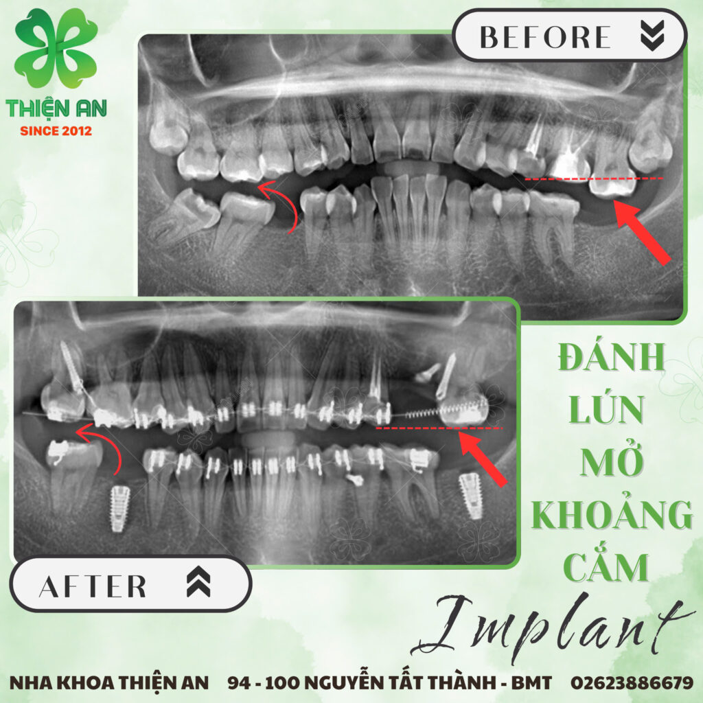 implant
