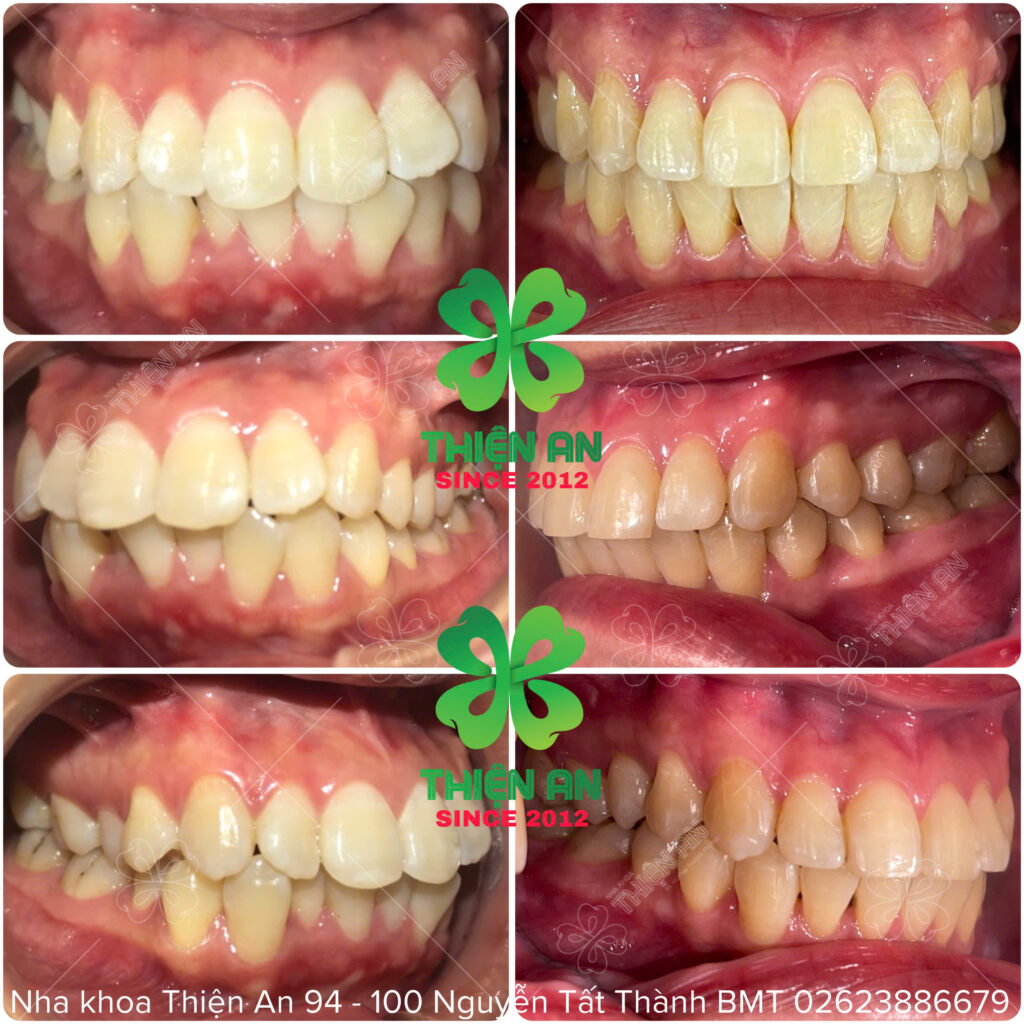 niềng răngniềng răng