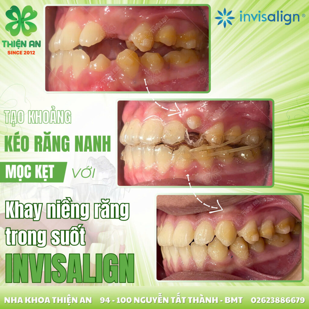 invisalign
