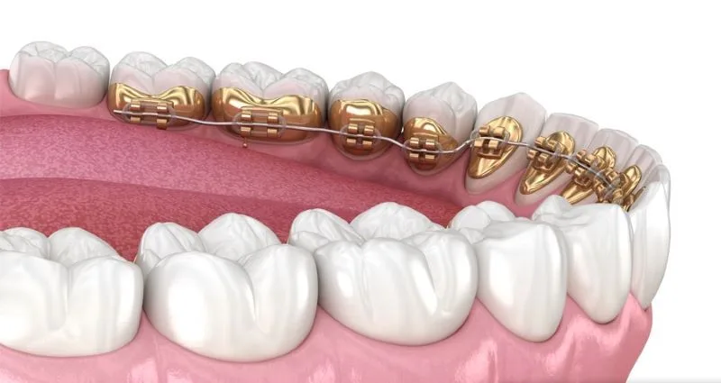 NIỀNG RĂNG MẮC CÀI KIM LOẠI LÀ GÌ? ƯU VÀ NHƯỢC ĐIỂM