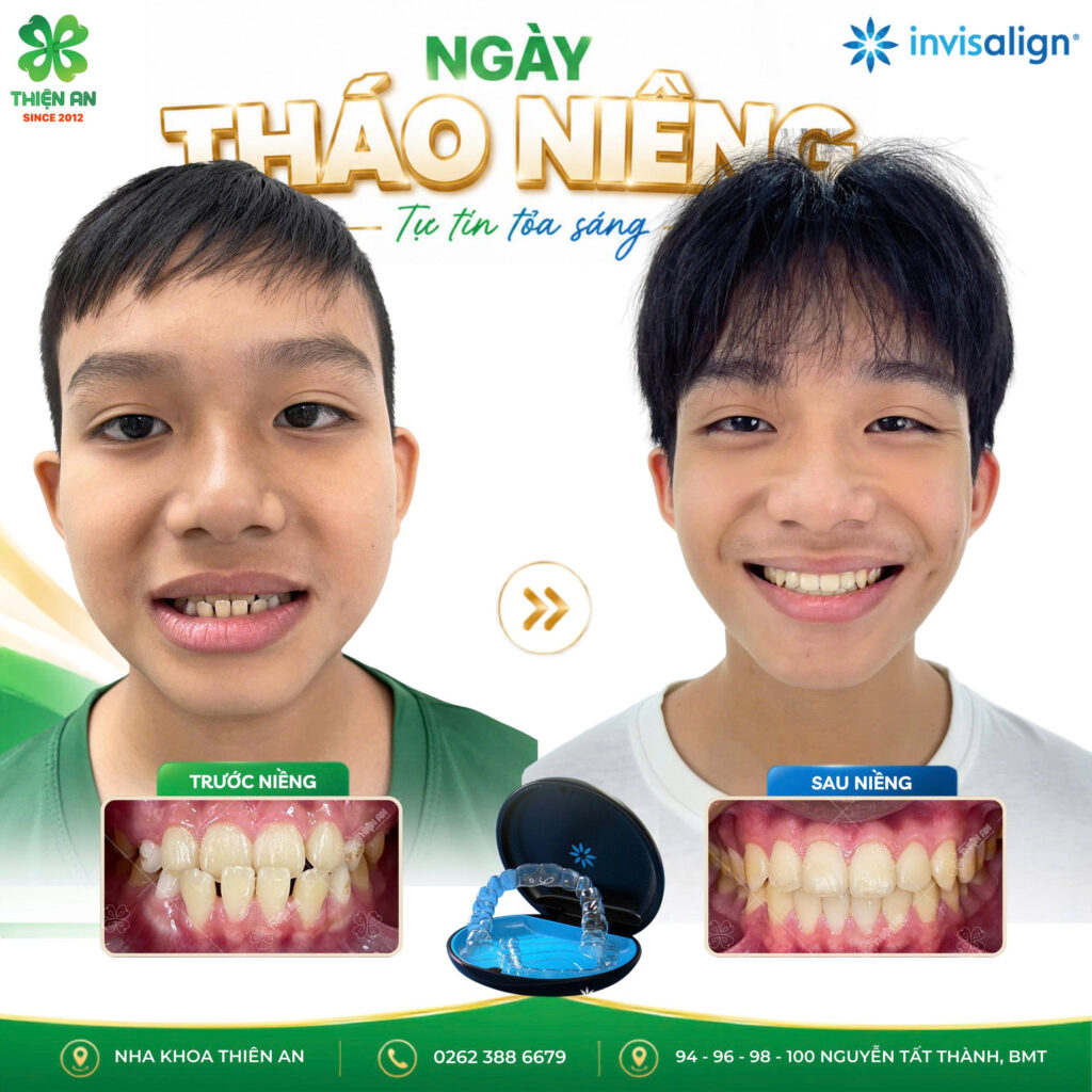 niềng răng invisalign