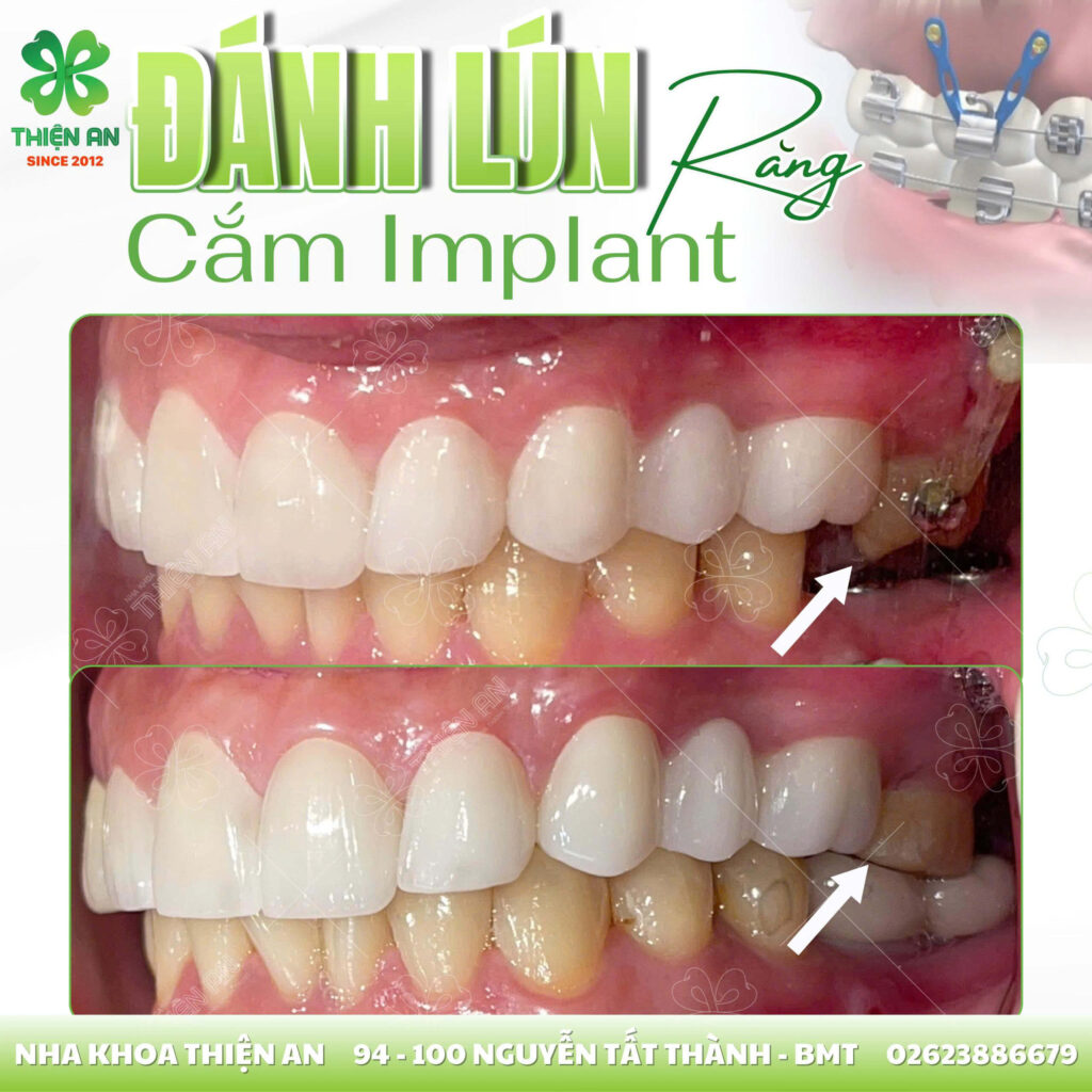 cấy ghép implant buôn ma thuột