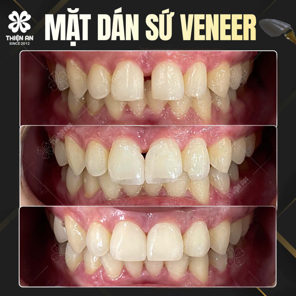 dán sứ veneer buôn ma thuột