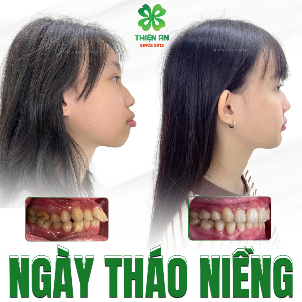 kinh nghiệm niềng răng
