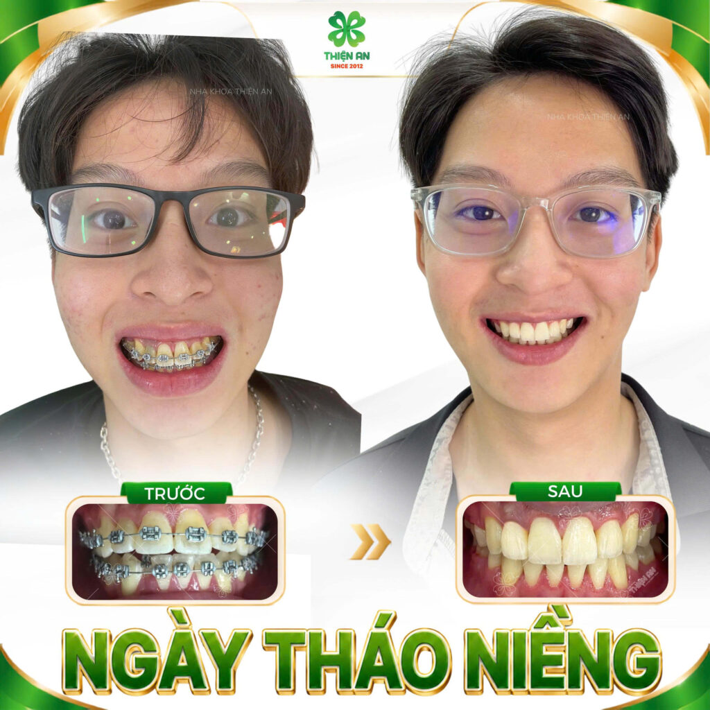 niềng răng buôn ma thuột
