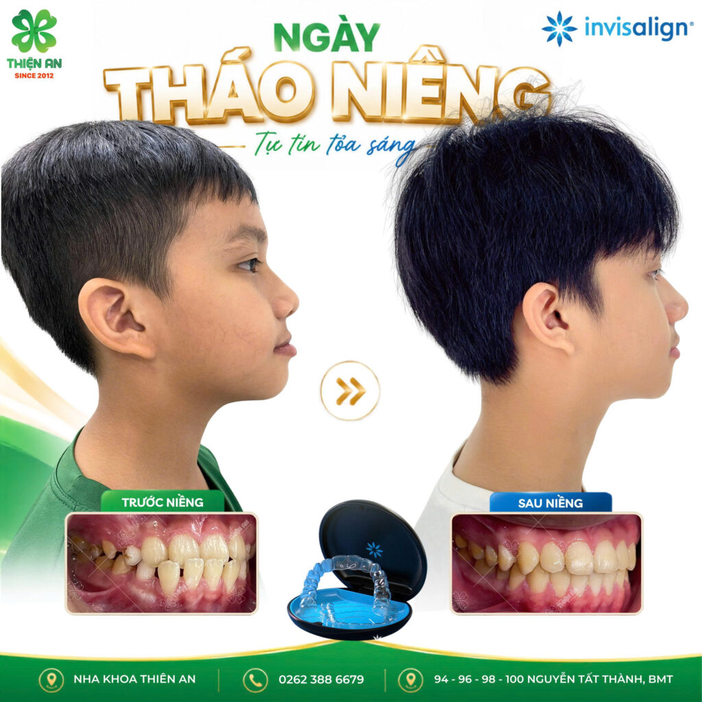 niềng răng invisalign buôn ma thuột