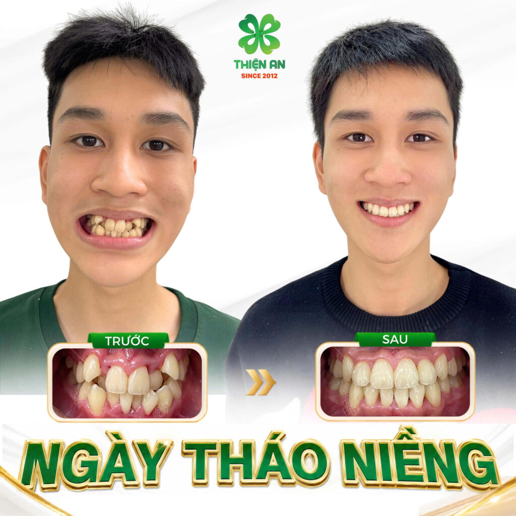 niềng răng buôn ma thuột