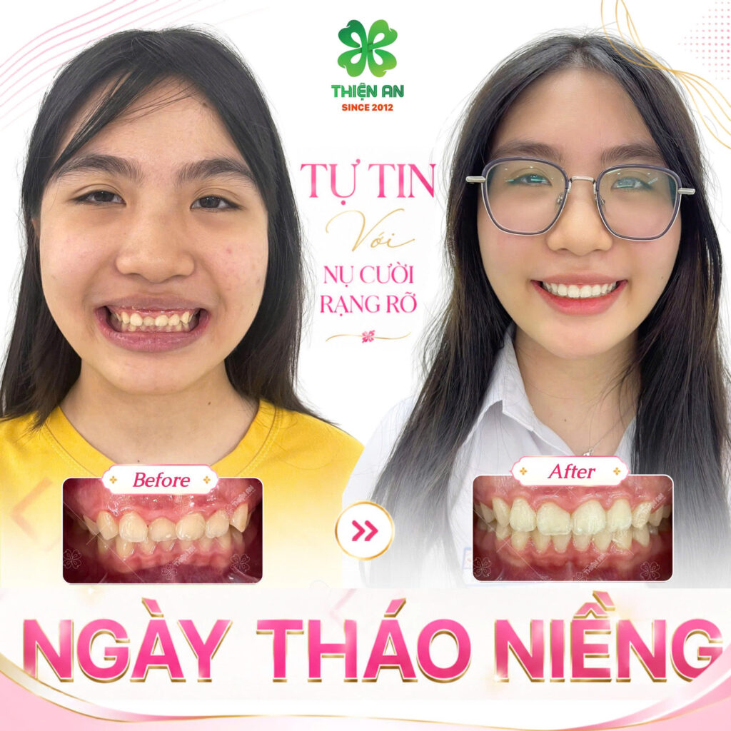 kinh nghiệm niềng răng