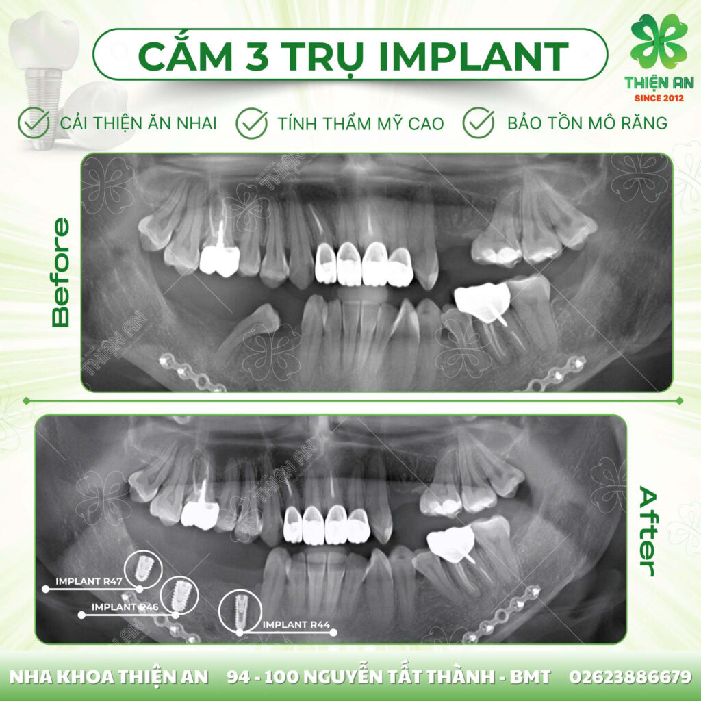 cấy ghép implant buôn ma thuột