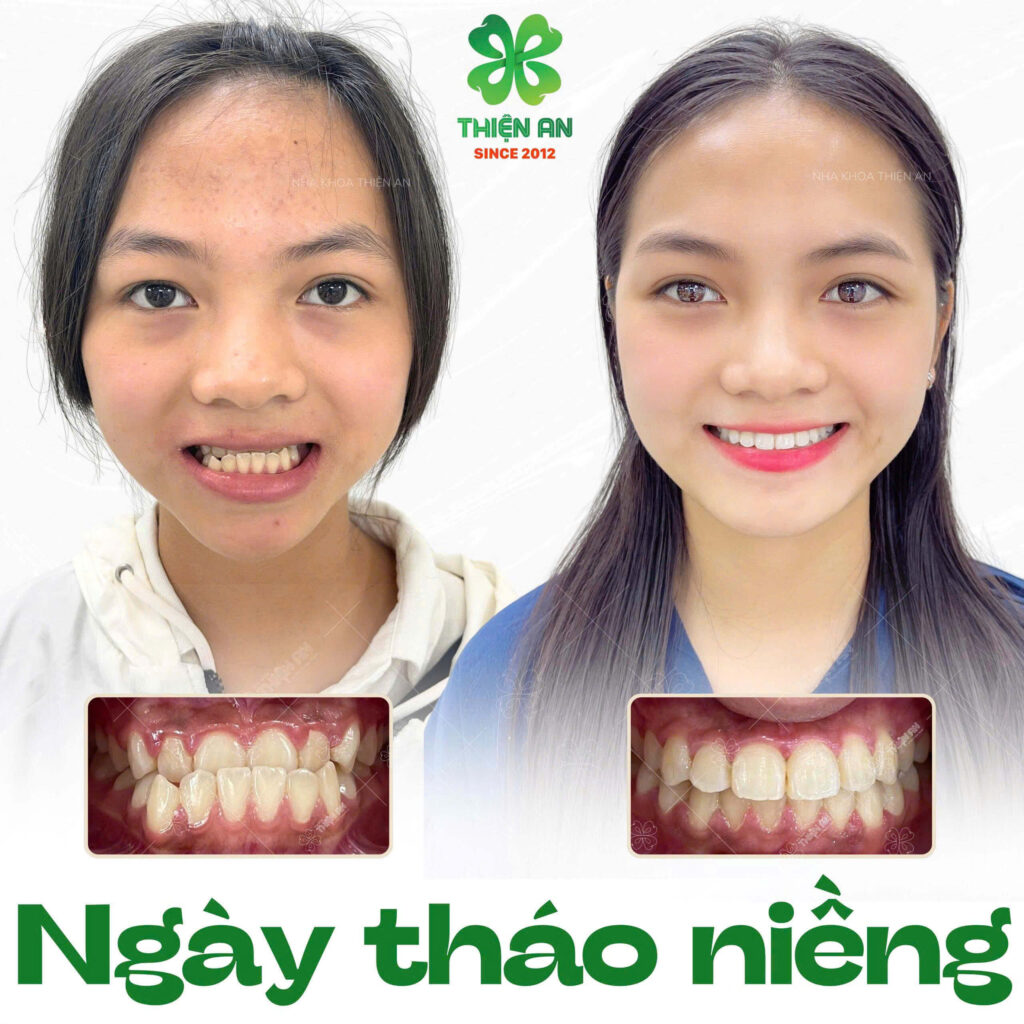 niềng răng buôn ma thuột
