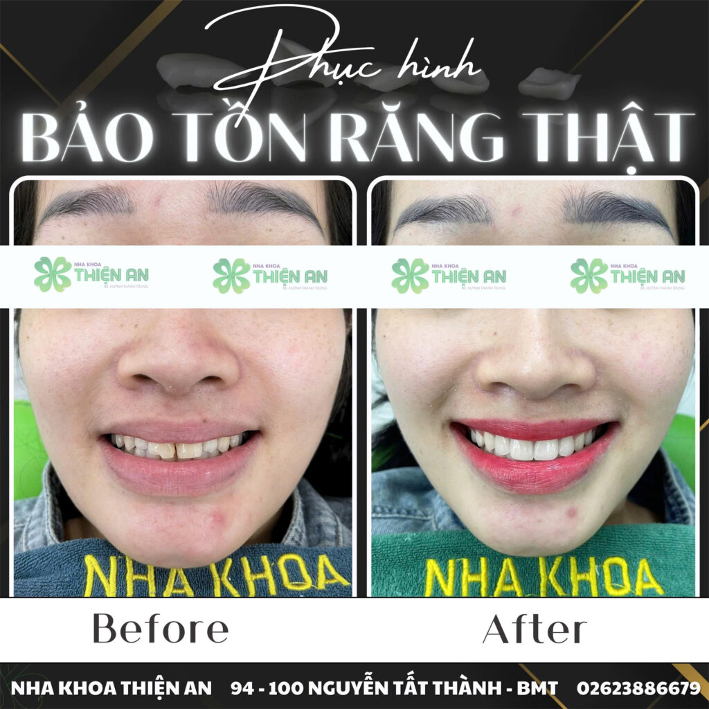 dán sứ veneer có bền không