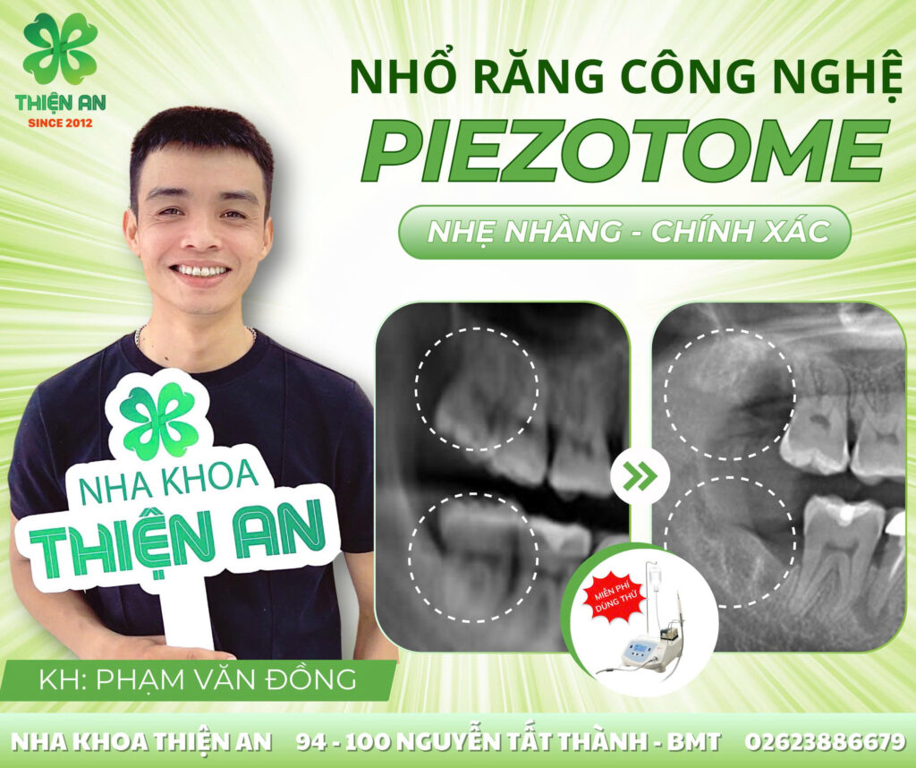 nhổ răng khôn có đau không