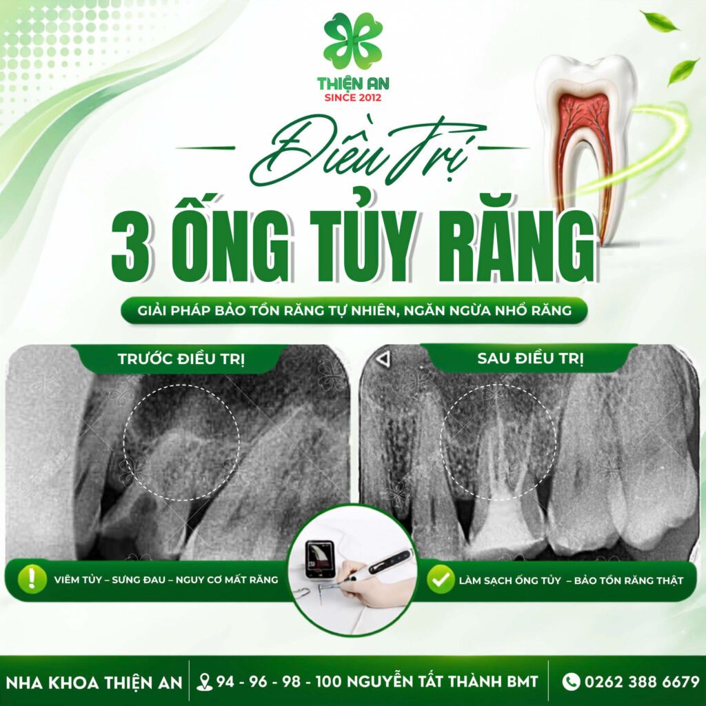 điều trị tủy