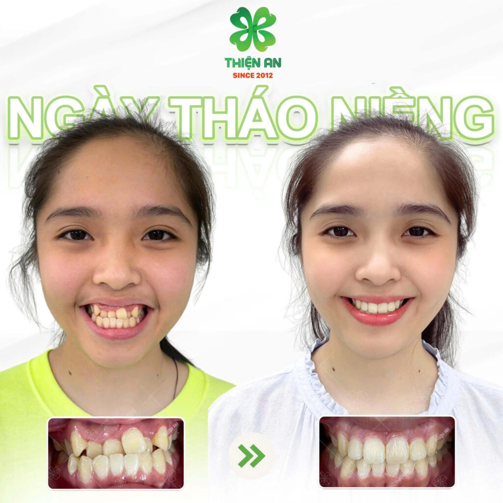 niềng răng có làm thay đổi khuôn mặt không