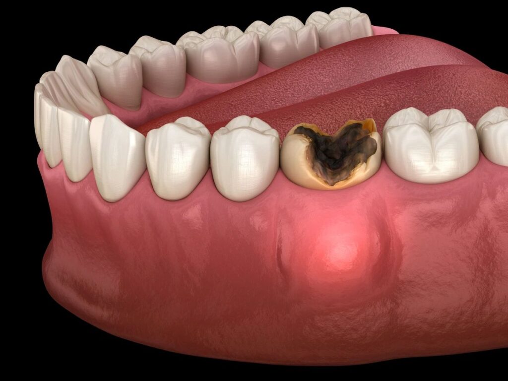 Sâu răng không điều trị có thể gây hậu quả gì?