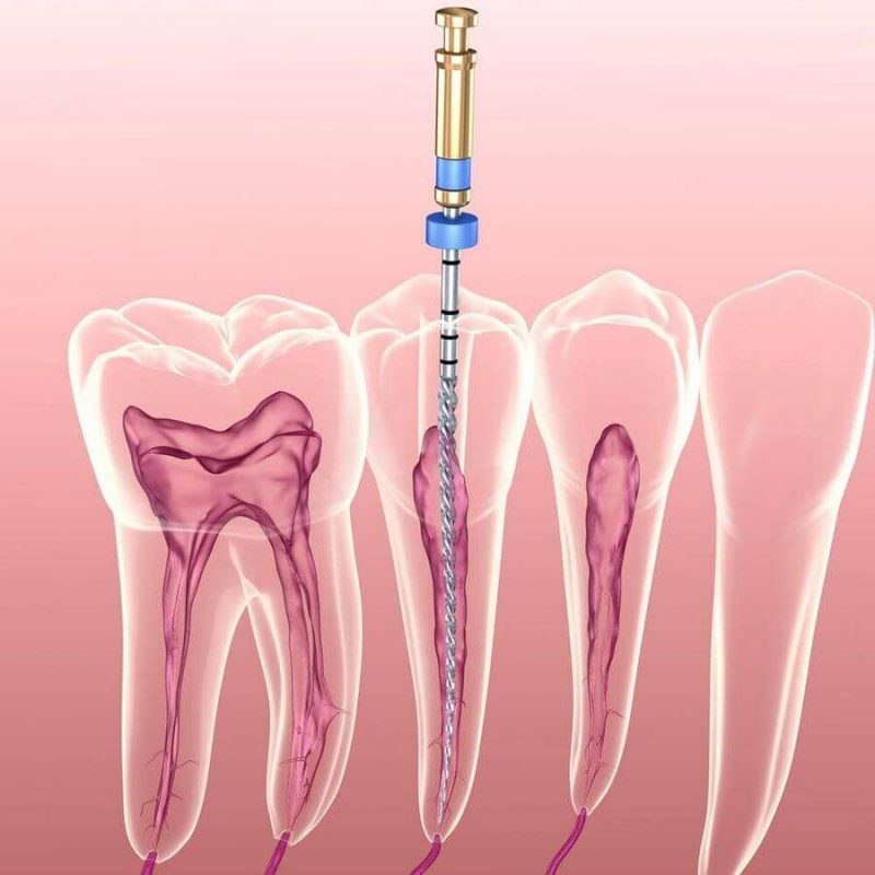 Điều trị tủy răng có đau không? Quy trình và những lưu ý cần biết