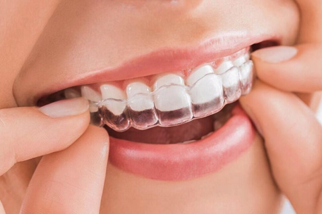 Niềng răng Invisalign mất bao lâu? Các yếu tố ảnh hưởng