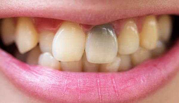 Răng chết tủy có cần điều trị không? Dấu hiệu và cách xử lý